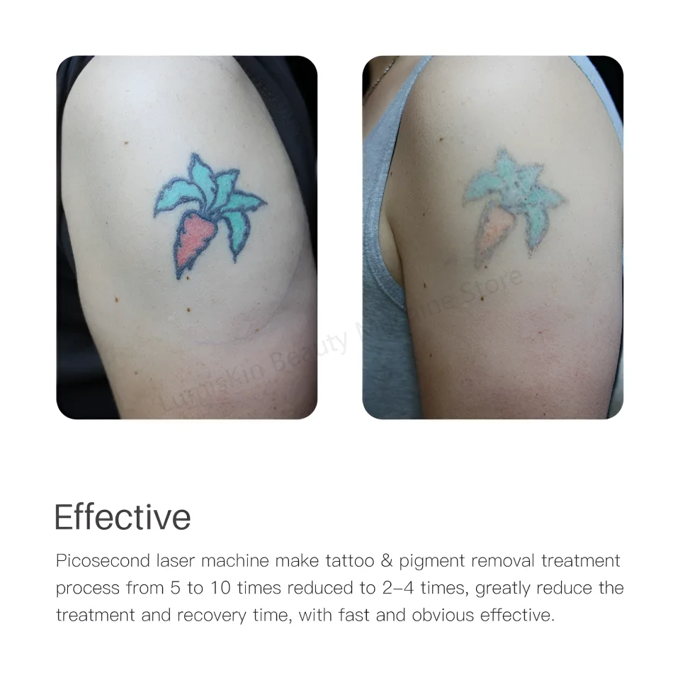 Máquina Láser Pico 532nm 1064nm para Eliminación de Tatuajes y Melasma, con Pantalla, Certificación CE/RoHS