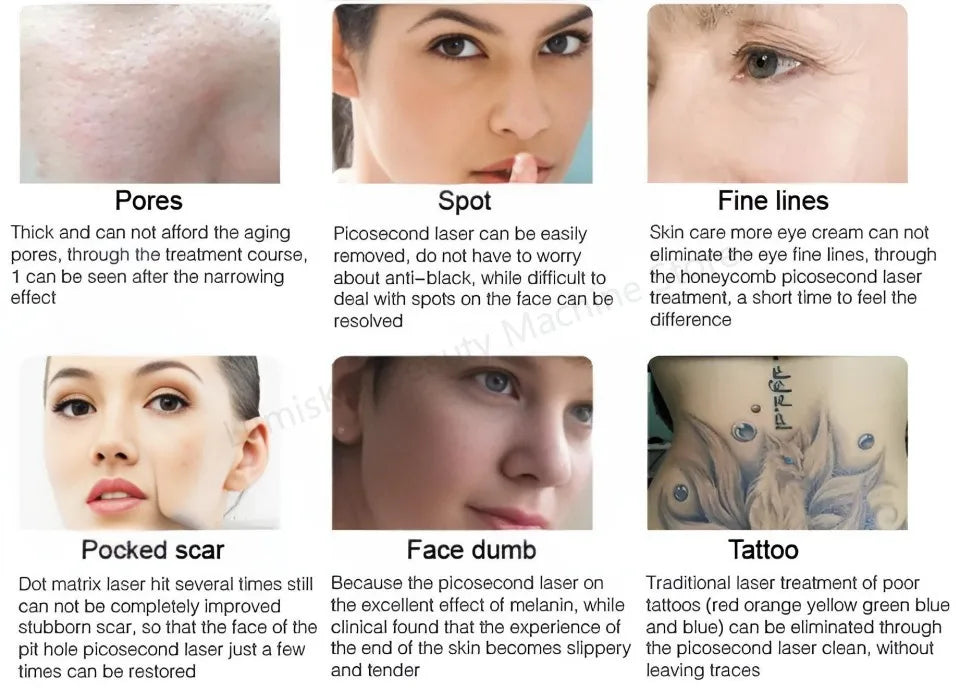 Máquina Láser Pico 532nm 1064nm para Eliminación de Tatuajes y Melasma, con Pantalla, Certificación CE/RoHS
