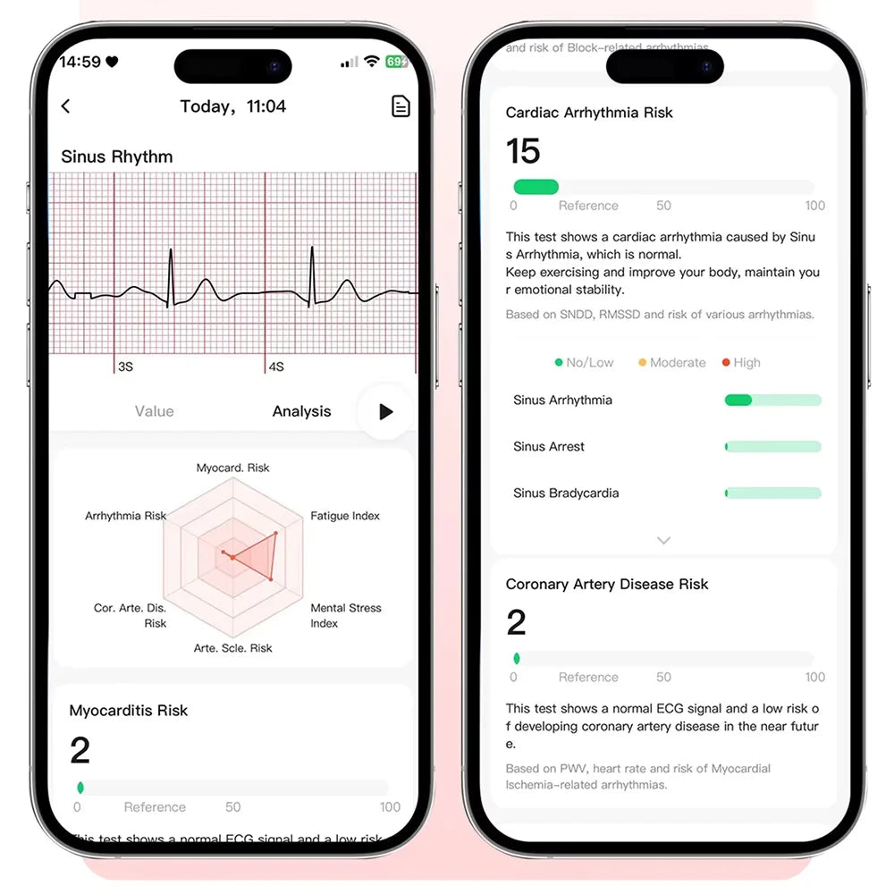 Reloj Inteligente Análisis de Salud ECG+PPG
